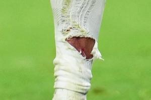 有点狠！塔蹬踏姆巴佩小腿染黄，姆巴佩小腿袜被踩破露出血痕