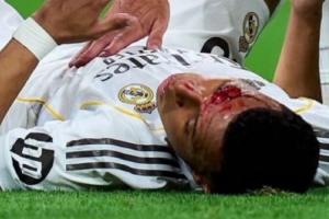 遭肘击血流不止！皇马官方：姆巴佩眉骨缝针，缺席球队今日合练