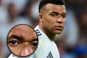 脸部挂彩！TA：姆巴佩预计能首发出战皇马对拜仁的欧冠